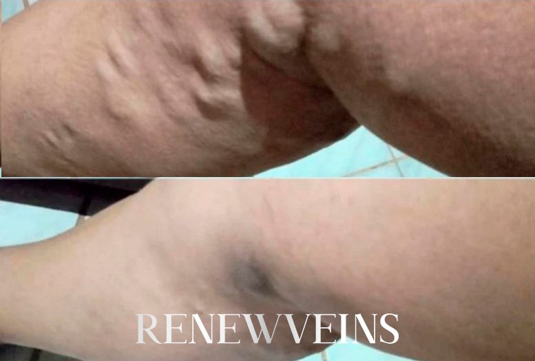 dep5_edit_renewveins2.jpg